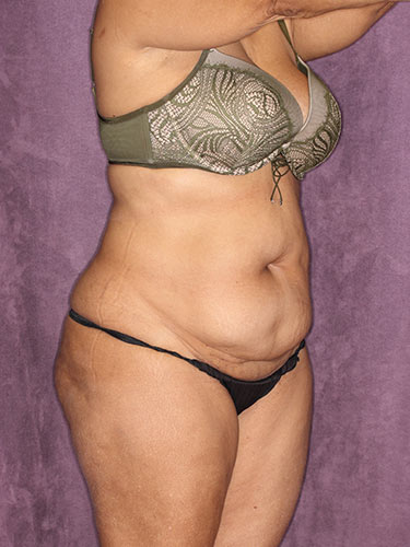 Case--32318 | Before Fat Transfer to Buttocks 2