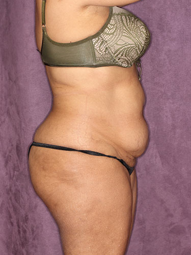 Case--32318 | Before Fat Transfer to Buttocks 3