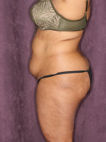 Case--32318 | Before Fat Transfer to Buttocks 5