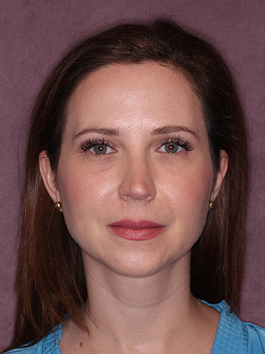 Case--32333 | After Facelift and Neck Lift 1
