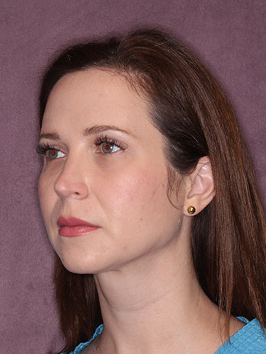 Case--32333 | After Facelift and Neck Lift 3