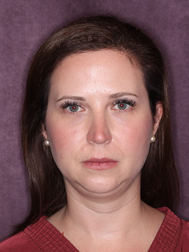 Case--32333 | Before Facelift and Neck Lift 1