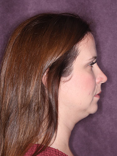 Case--32333 | Before Facelift and Neck Lift 2