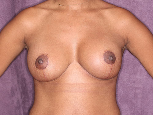 Case--32366 | After Corrective/Revision Breast Implant Surgery 1