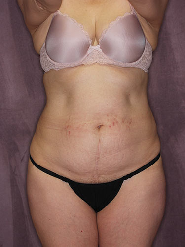 Case--32549 | Before Liposuction 1