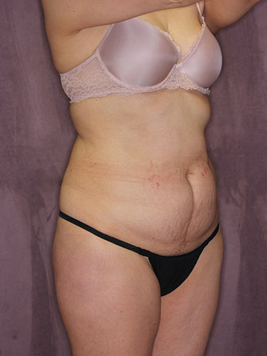 Case--32549 | Before Liposuction 2