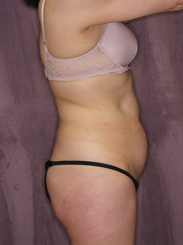 Case--32549 | Before Liposuction 3