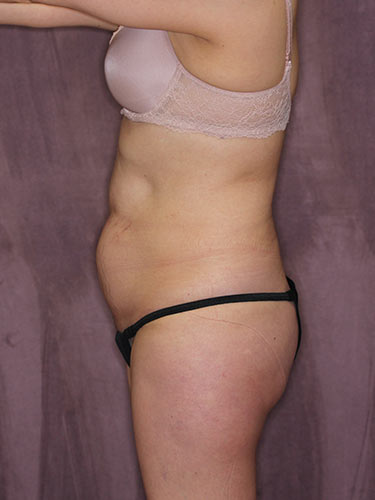 Case--32549 | Before Liposuction 5