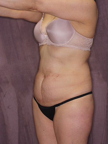 Case--32549 | Before Liposuction 6