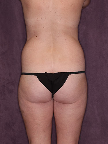Case--32535 | Before Liposuction 4