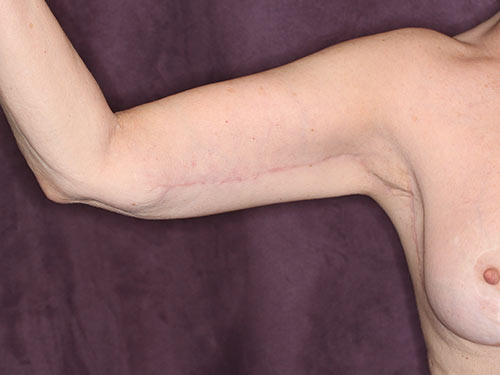Case--32606 | After Arm Lift 1