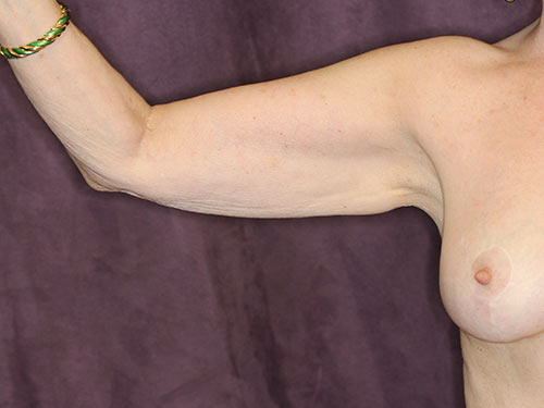 Case--32606 | Before Arm Lift 1