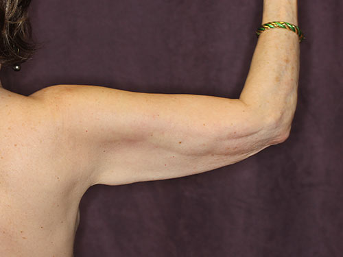 Case--32606 | Before Arm Lift 3
