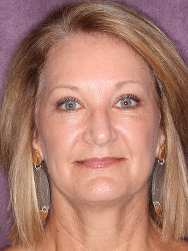 Case--32616 | After Eyelid Surgery (Blepharoplasty) 1
