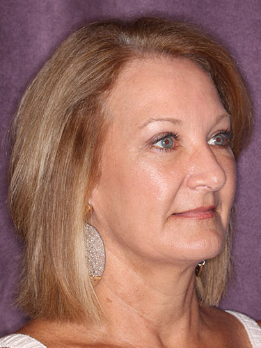 Case--32616 | After Eyelid Surgery (Blepharoplasty) 2