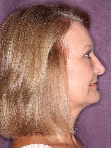 Case--32616 | After Eyelid Surgery (Blepharoplasty) 3