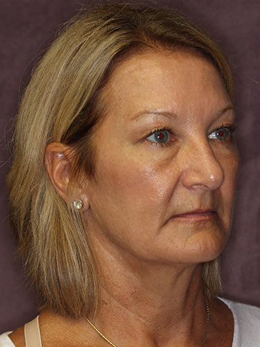 Case--32616 | Before Eyelid Surgery (Blepharoplasty) 2