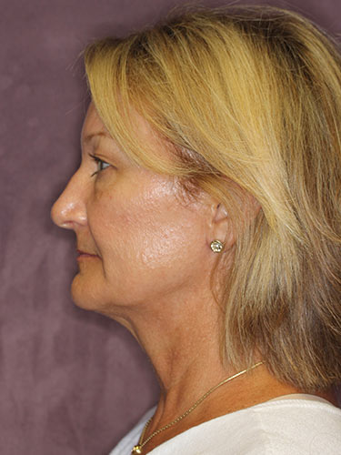 Case--32616 | Before Eyelid Surgery (Blepharoplasty) 4