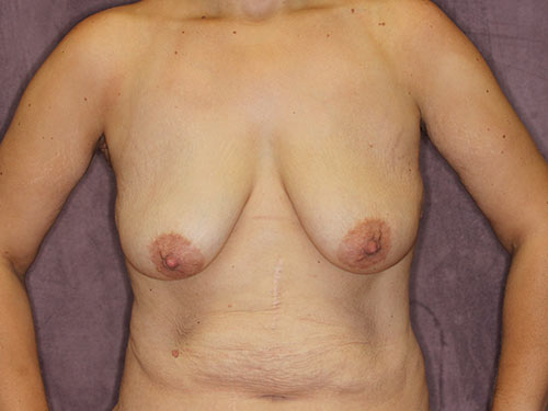 Case--32656 | Before Breast Augmentation 1