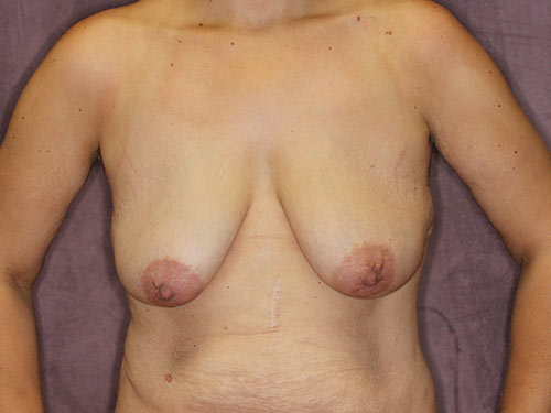 Case--32656 | Before Breast Augmentation 5