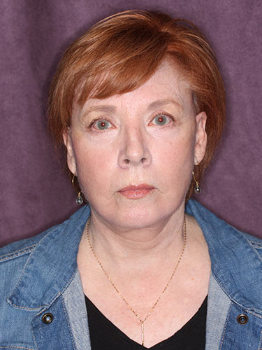 Case--32669 | After Facelift and Neck Lift 1