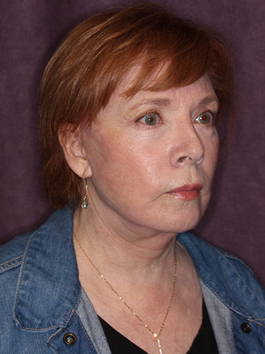Case--32669 | After Facelift and Neck Lift 2