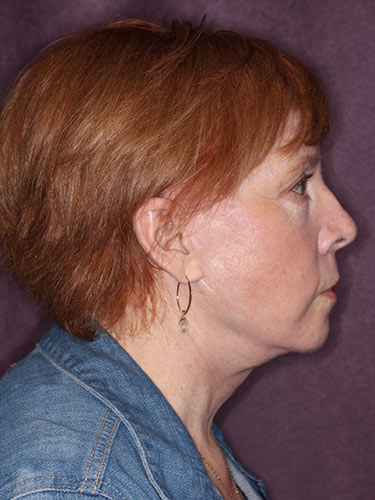 Case--32669 | After Facelift and Neck Lift 3