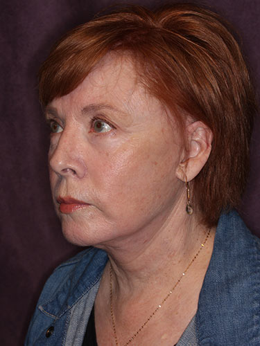 Case--32669 | After Facelift and Neck Lift 5