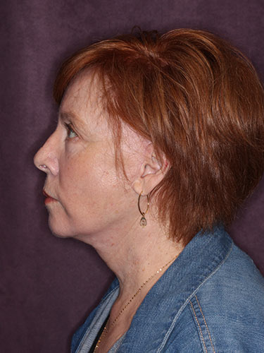 Case--32669 | After Facelift and Neck Lift 4