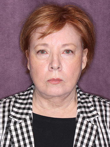 Case--32669 | Before Facelift and Neck Lift 1