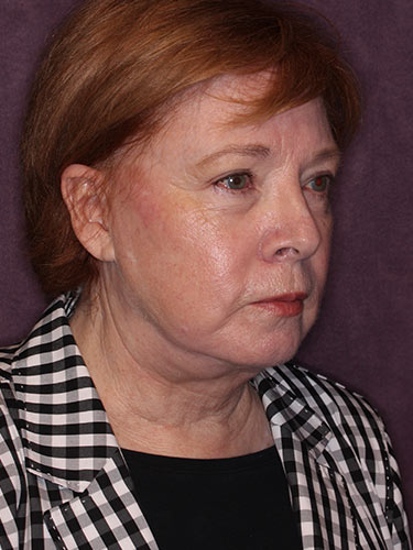 Case--32669 | Before Facelift and Neck Lift 2