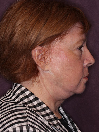 Case--32669 | Before Facelift and Neck Lift 3