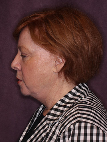 Case--32669 | Before Facelift and Neck Lift 4
