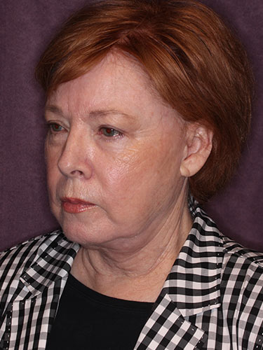 Case--32669 | Before Facelift and Neck Lift 5